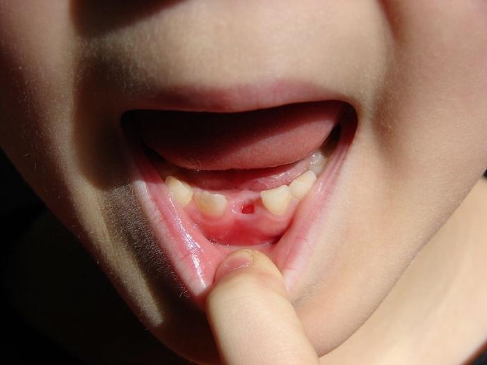 Czy to straszna zmiana zębów u dziecka, jak myślą rodzice?