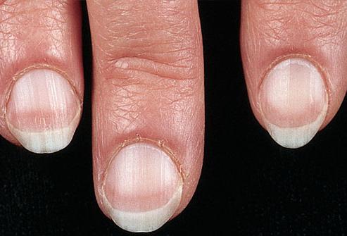 Czy choroby rąk paznokcia są niebezpieczne?